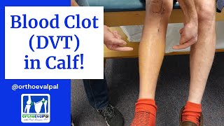 Blood Clot DVT in the Calf Actual Patient Presentation [upl. by Irisa]