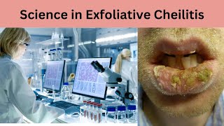 Exploring the Science of Exfoliative Cheilitis Unraveling the Mysteries [upl. by Iroj]