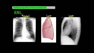 Identifying Lung Lobes on Frontal and Lateral Chest XRays UndergroundMed [upl. by Nicholle]