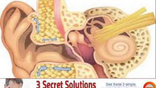 vagus nerve stimulation tinnitus [upl. by Oran818]