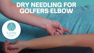 Dry Needling for Golfers Elbow  Medial Epicondylitis [upl. by Darice]