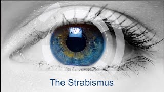 The Strabismus 4  HeteroTropia Amblyopia  Squint management [upl. by Neeloj]