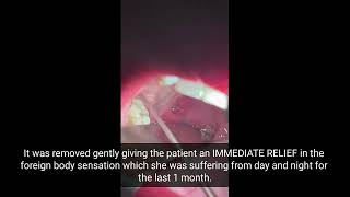 Immediate Relief after HUGE TONSIL STONE Removal  How to remove TONSIL STONE [upl. by Firahs]