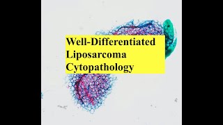 Lipomatous Tumor Cytopathology Interesting Case Conference [upl. by Suiradel]