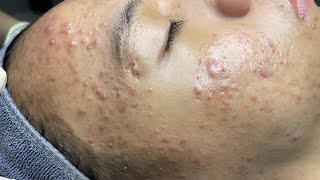 ACNE TREATMENT VU QUYNH MI  Perennial Blackheads On Boy Face 2024FULL [upl. by Nnylrac]