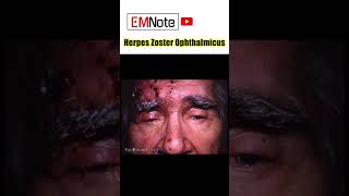 Herpes zoster ophthalmicus [upl. by Guenna]