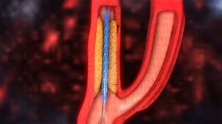 Carotid Artery Stenting video [upl. by Aenel]