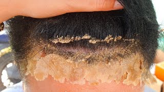 Flaky Dandruff Scratching Scalp Psoriasis 255 [upl. by Iredale260]