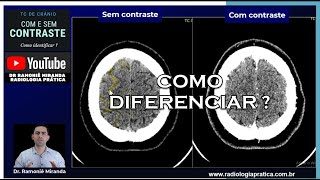 Como saber se a tomografia de crânio foi feita com ou sem contraste venoso [upl. by Nylirak661]