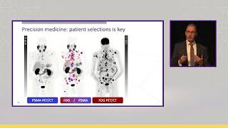 How I Select Patients for LutetiumPSMA Radioligand Therapy [upl. by Ahsenal687]