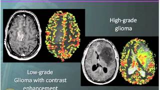 Surgery of LowGrade Gliomas [upl. by Rbma]