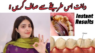 The 1 top remedy for dental plaque TARTAR [upl. by Shorter]