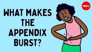 What does appendix pain feel like  David R Flum [upl. by Kamin]