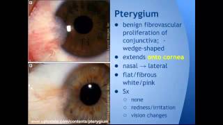 Pterygium vs Pinguecula quotEM in 5quot [upl. by Aesoh]