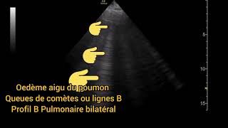 Oedème aigu du poumon Syndrome interstitiel Queues de comètes Lignes B Échographie Pulmonaire [upl. by Nelda]