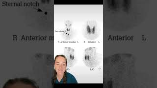 Nuclear Medicine Exams Explained Thyroid Uptake and Scan [upl. by Gris]