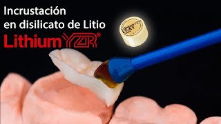 Incrustación en disilicato de litio Lithium YZR [upl. by Mitzie]