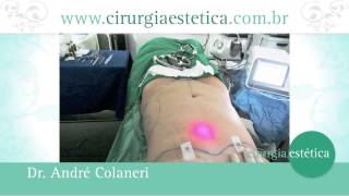 Lipo a Laser como funciona e qual a vantagem [upl. by Azalea274]