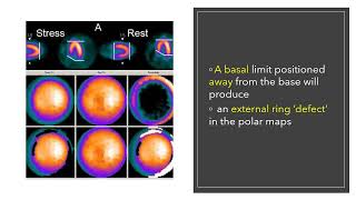 Artifacts in Nuclear Cardiology MCQs nuclearmedicineMCQ nuclearmedicine physics RSO frcr [upl. by Anilorac]