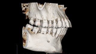 How to create a cephalometric radiograph from CBCT [upl. by Yregerg]