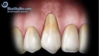 Patient Treatment Videos Gingival Graft Alloderm [upl. by Ellivnarg]