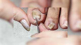 Watch This Clients Pincer Toenail Reversal [upl. by Wun38]