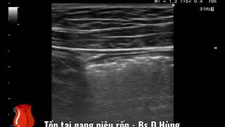 Case 53  Urachal cyst infection  Tồn tại nang niệu rốn nhiễm trùng [upl. by Iraj]