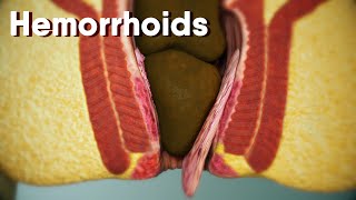 Hemorrhoidsdifferent types of hemorrhoids internal and external Hemorrhoids Hemorrhoids treatment [upl. by Adalie]