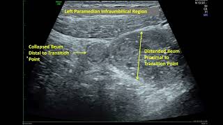 Bowel Adhesion Causing Subacute Small Bowel ObstructionUltrasound Demonstration of Transition Point [upl. by Yarased]