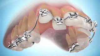 Alignement orthodontique 2 canines [upl. by Truk819]