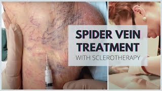 Reticular veins and spider vein treatments [upl. by Darnoc611]