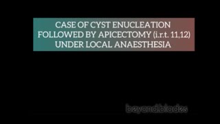 Cyst Enucleation with Apicectomy of 11 and 12 teeth under local anaesthesia [upl. by Aleuqahs]