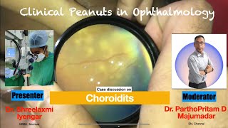 Case discussion on Choroiditis [upl. by Jenilee]