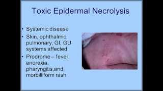 Dermatology Emergencies TEN vs Stevens Johnson Syndrome [upl. by Anirbak]