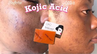 I USED KOJIC ACID SOAP FOR A MONTH  Honest Review Tips How to use 2022  Trinidad YouTuber [upl. by Esyla]