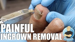 TREATING AN EXTREMELY PAINFUL INGROWN TOENAIL WITH HOW TO ADVICE [upl. by Goldia662]