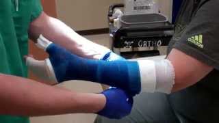 Application of a Thumb Spica Cast [upl. by Eseerehc514]