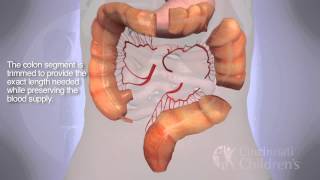 Segmental Colonic Interposition for Esophageal Atresia 3D Animation [upl. by Nhguavaj]