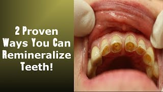 2 Little Known Ways To Achieve Tooth Remineralization Easy To Implement [upl. by Anoval]