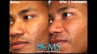 BeforeAfter African American Male Laser Acne Scar Removal Results [upl. by Eittak70]