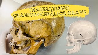 Caso clínico Traumatismo cranioencefálico grave [upl. by Dric]