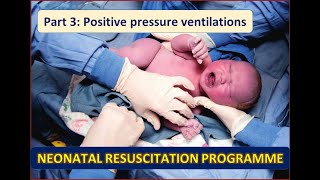 Neonatal Resuscitation Program  Part 3  Positive pressure ventilation  Bag and mask ventilation [upl. by Adnoloy248]