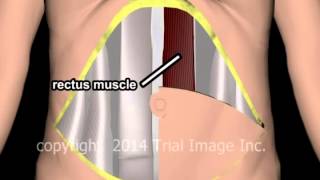 Breast Reconstruction TRAM  animation amp narration by Cal Shipley MD [upl. by Nosnah]