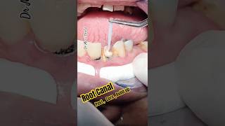 POST CORE Build up tooth after Root Canal [upl. by Hortense341]