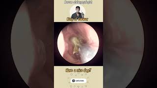 rhinorrhea sinusitis bersihkankuping satisfyingvideos pembersihan telinga video puas hati [upl. by Columbine]