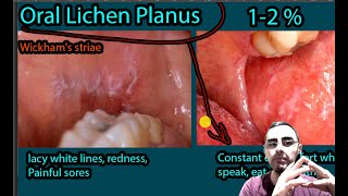 Oral Lichen Planus  Symptoms Causes Treatment Wickhams striae [upl. by Anaerb448]