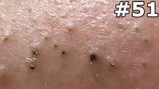 quot🔴 Satisfying Pimple Popping Extravaganza Watch the Most Satisfying Pops Everquot 51 [upl. by Ramsa]