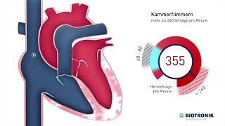 Kammerflimmern amp plötzlicher Herztod Animation [upl. by Yrrak100]