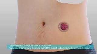 Confort Colostomy Ileostomy Bag Application Video [upl. by Tonia]