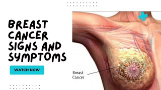 Breast Cancer Signs and Symptoms What to Watch For [upl. by Devonna]